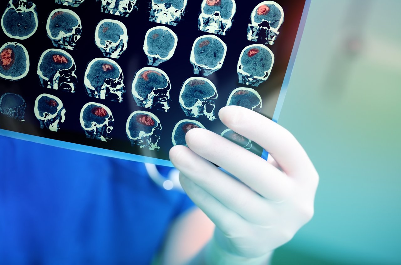 doctor examines mri brain scan doctor examines mri brain scan